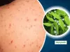 चेचक का घरेलू इलाज : चेचक का घरेलू इलाज करने के लिए उपाय