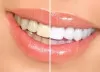 Teeth Wheiting Tips