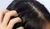 <b>Dandruff Treatment</b> : डैंड्रफ की समस्या से छुटकारा